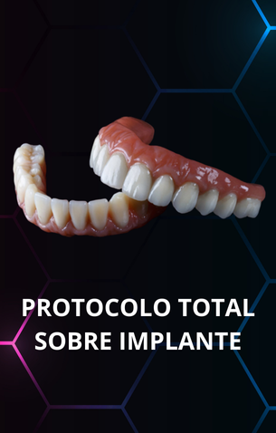 PROTOCOLO TOTAL SOBRE IMPLANTE (1)